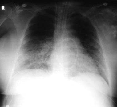 Pneumonia, viral: A 52-year-old woman developed fe