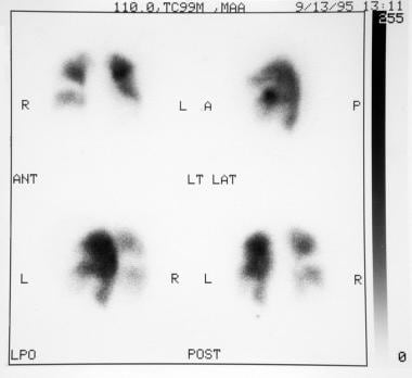 What Is The Role Of Ventilation Perfusion Scanning For The