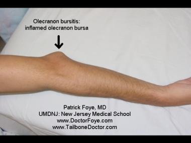 Olecranon bursitis seen with the elbow extended. F