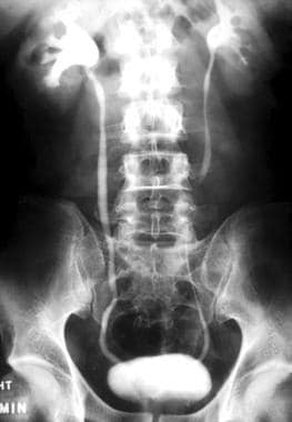 kidney stones kub xray