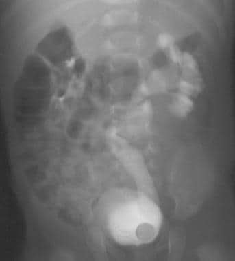 ureterocele ivp