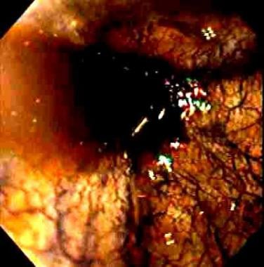 Caustic ingestions. Endoscopic view of the esophag
