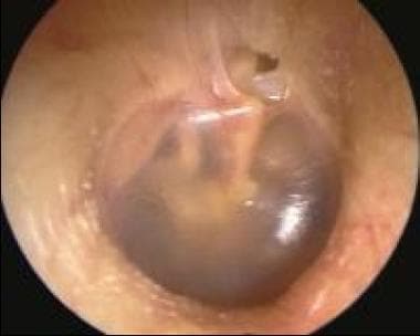 Epitympanic (attic) cholesteatoma. This is a typic