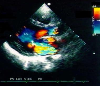 Color-Doppler echocardiography of a child with mit