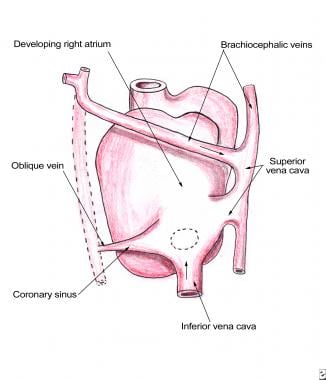 Pediatric Surgery for Unroofed Coronary Sinus. Emb