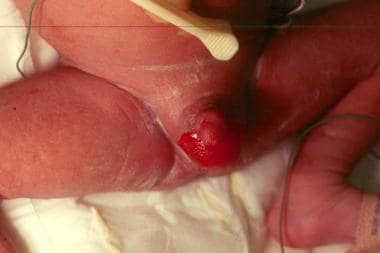 Congenital localized absence of skin on the scrotu