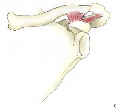 Type I fracture of the distal clavicle (group II).