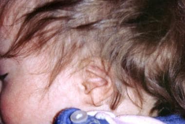 Small auricle and anomalies of folds in patient wi