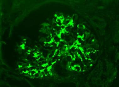 Mesangial deposits of immunoglobulin A (IgA). Fluo