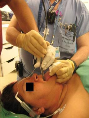 With the bronchoscope in the trachea, the endotrac