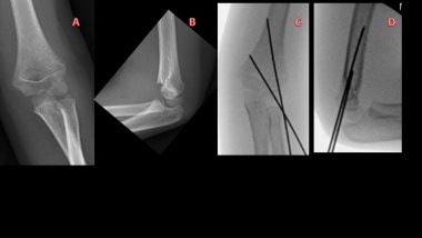 (A, B) Elbow radiographs of 5-year-old boy with ty