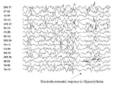 脑电图显示hypsarrhythmia。