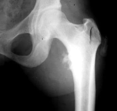 Osteochondrosis of the lesser trochanter of the le