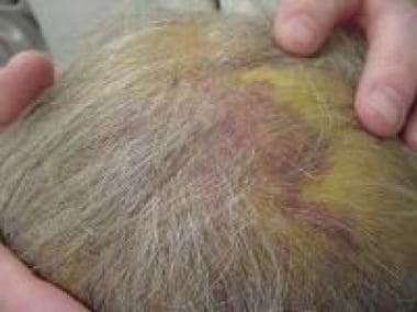 The most common presentation of a scalp angiosarco