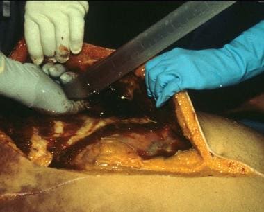 Checking for a pneumothorax at autopsy. 