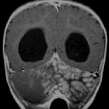 Medulloblastoma Pathology. A lateral cerebellar ma