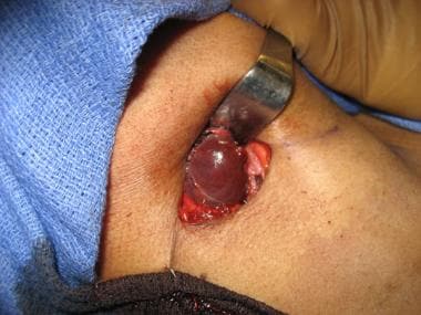 Direct approach to ectopic parathyroid adenoma see