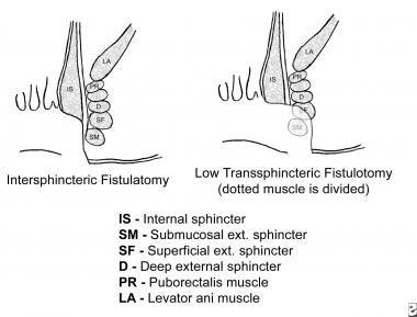 Schematic of intersphincteric and low transsphinct