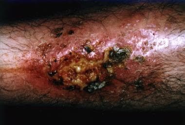 Pyoderma gangrenosum. Courtesy of Dr. Gene Izuno. 