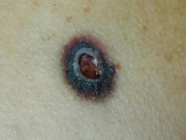 Contact gunshot wound with a margin of seared soot