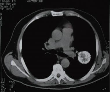The parenchymal lesion in this computed tomography