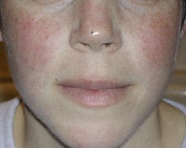 The classic malar rash, also known as a butterfly 