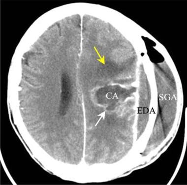 Brain abscess. Axial contrast-enhanced CT scan in 