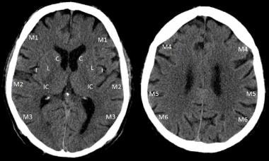 ASPECTS quantitative stroke scoring system: For AS