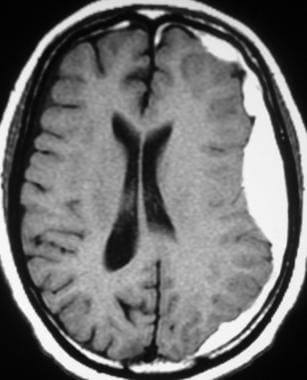 subdural hematoma mri