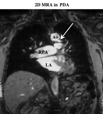 Coronal breath-hold magnetic resonance angiogram. 