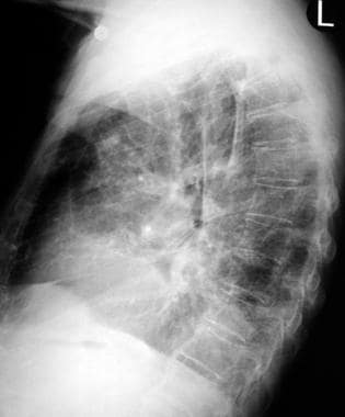 Aspiration pneumonia. Lateral radiograph in an 84-