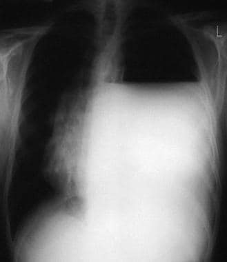 A chest radiograph in a patient with a recent hist