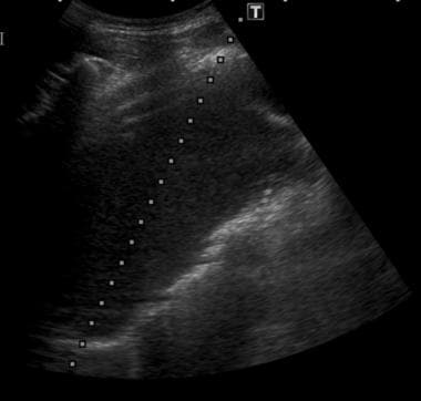 Ultrasound guidance used for transthoracic aspirat