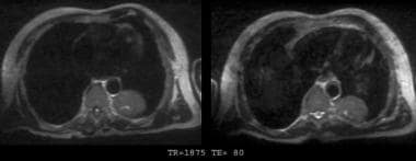 T2-weighted magnetic resonance images of the same 