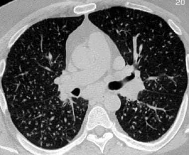 Sarcoidosis, thoracic. High-resolution CT scan in 