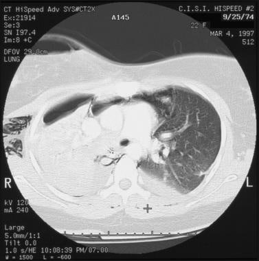 5-mm axial computed tomography (CT) scan with the 