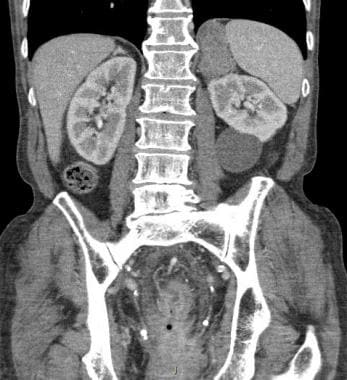 Same patient (62-year-old man with rectal carcinom