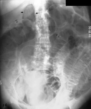 Pneumoperitoneum. Plain abdominal radiograph of a 