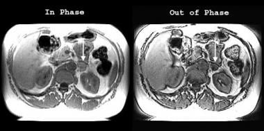 MRIs obtained with in-phase (left) and out-of-phas