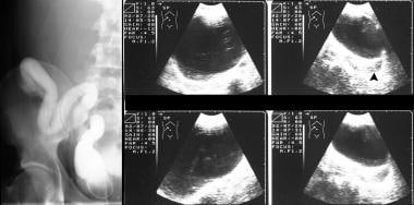 Right panel: Sonograms in a 16-year-old male adole