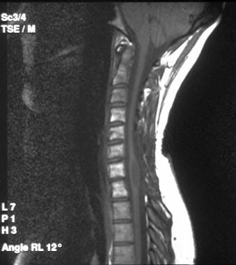 Sagittal T1-weighted MRI of the cervical spine in 