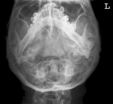 Mandibular Fracture Imaging: Overview, Radiography, Computed Tomography