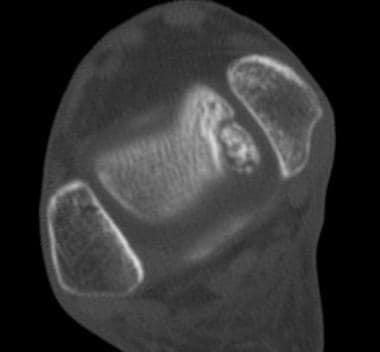 Axial CT of the ankle reveals osteochondritis diss