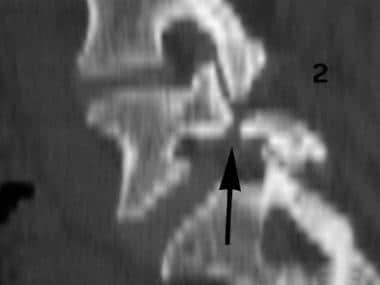 Spondylolisthesis. Sagittal CT reconstruction imag