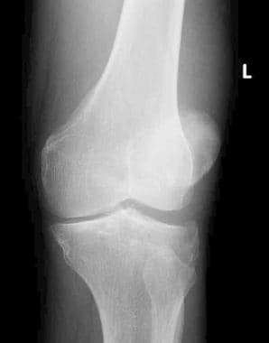 Tibial plateau fractures. Oblique radiograph of th