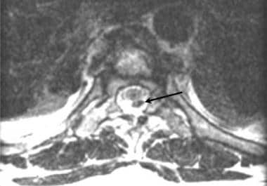 Thoracic spine trauma. Axial T1-weighted MRI image
