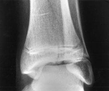 Anteroposterior radiograph from a 13-year-old girl