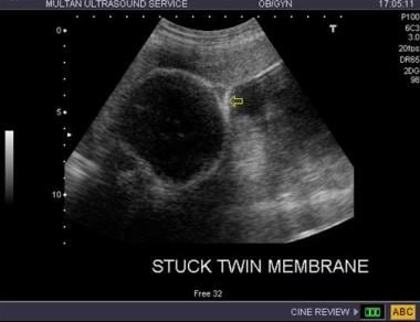 Twin-twin transfusion syndrome. Stuck twin: the ar