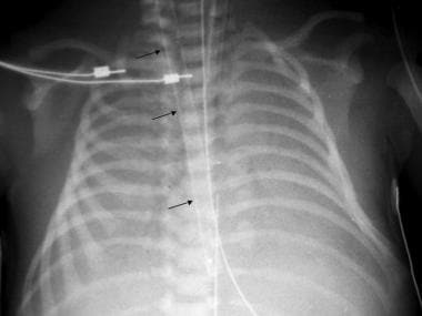 Meconium Aspiration Syndrome