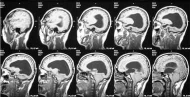 T1-weighted coronal MRIs of the brain in the same 